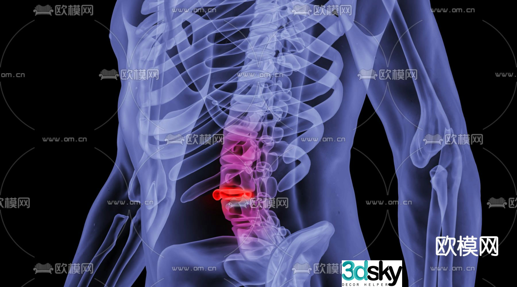 Lumbar disc herniation 3d model