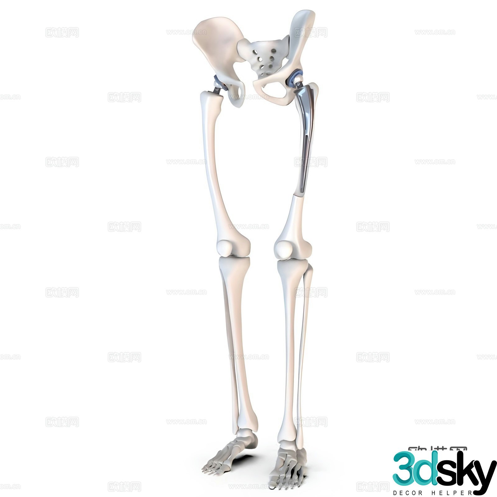 Hip replacement implant 3D model